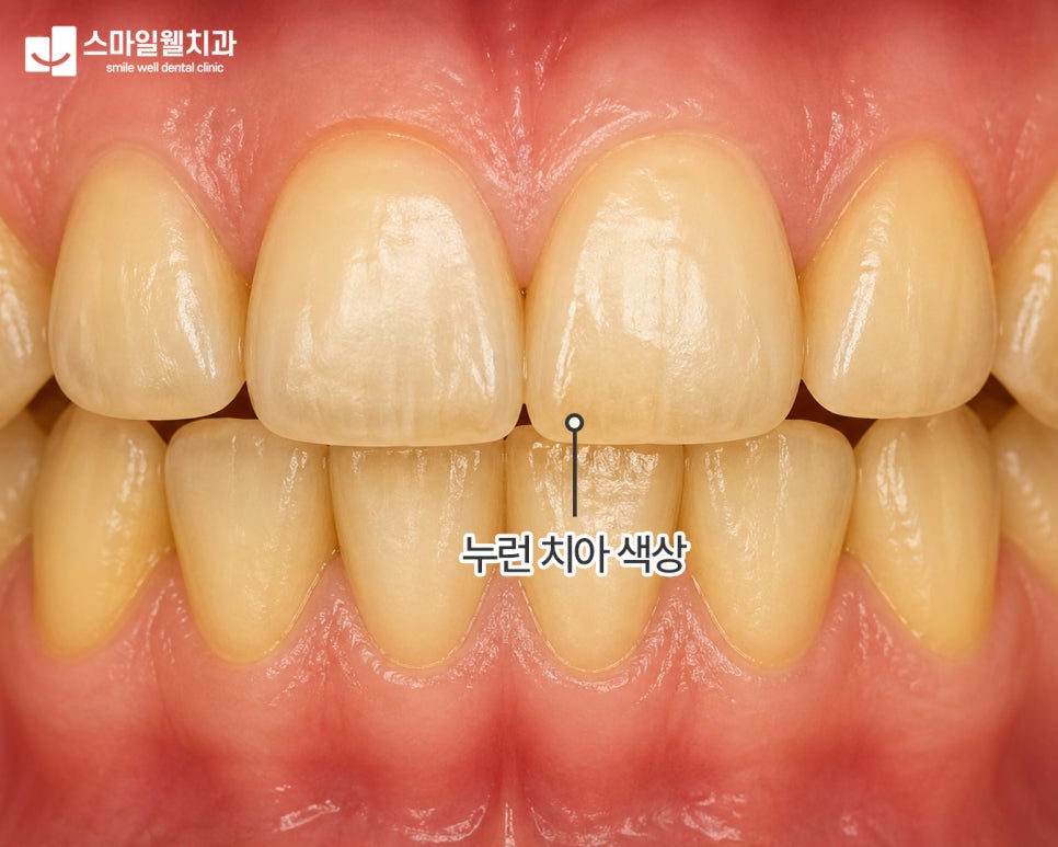 치아미백, 누런 치아 밝게 만드는 방법은? [원인·주의사항]