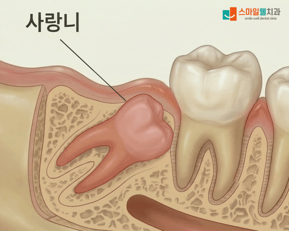 사랑니 발치, 통증과 부작용이 걱정된다면? [과정·주의사항 정리]