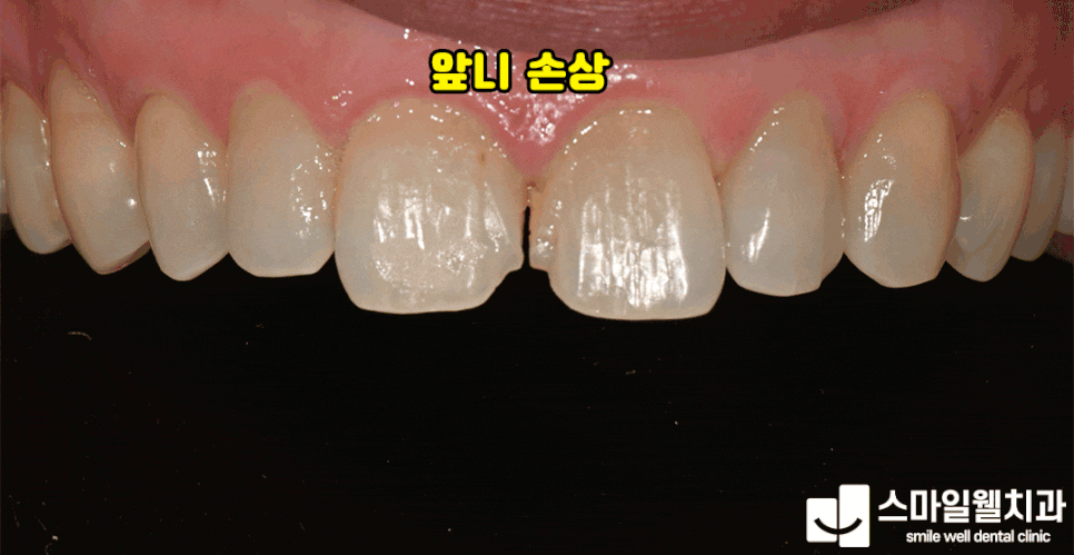 앞니 레진 치료, 왜 과정이 중요할까요? [심미성·보존성 정리]