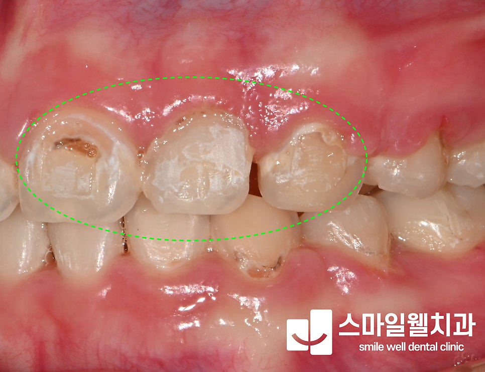 앞니 레진 치료, 당일 하루 만에 가능한가요? [방법·주의사항]