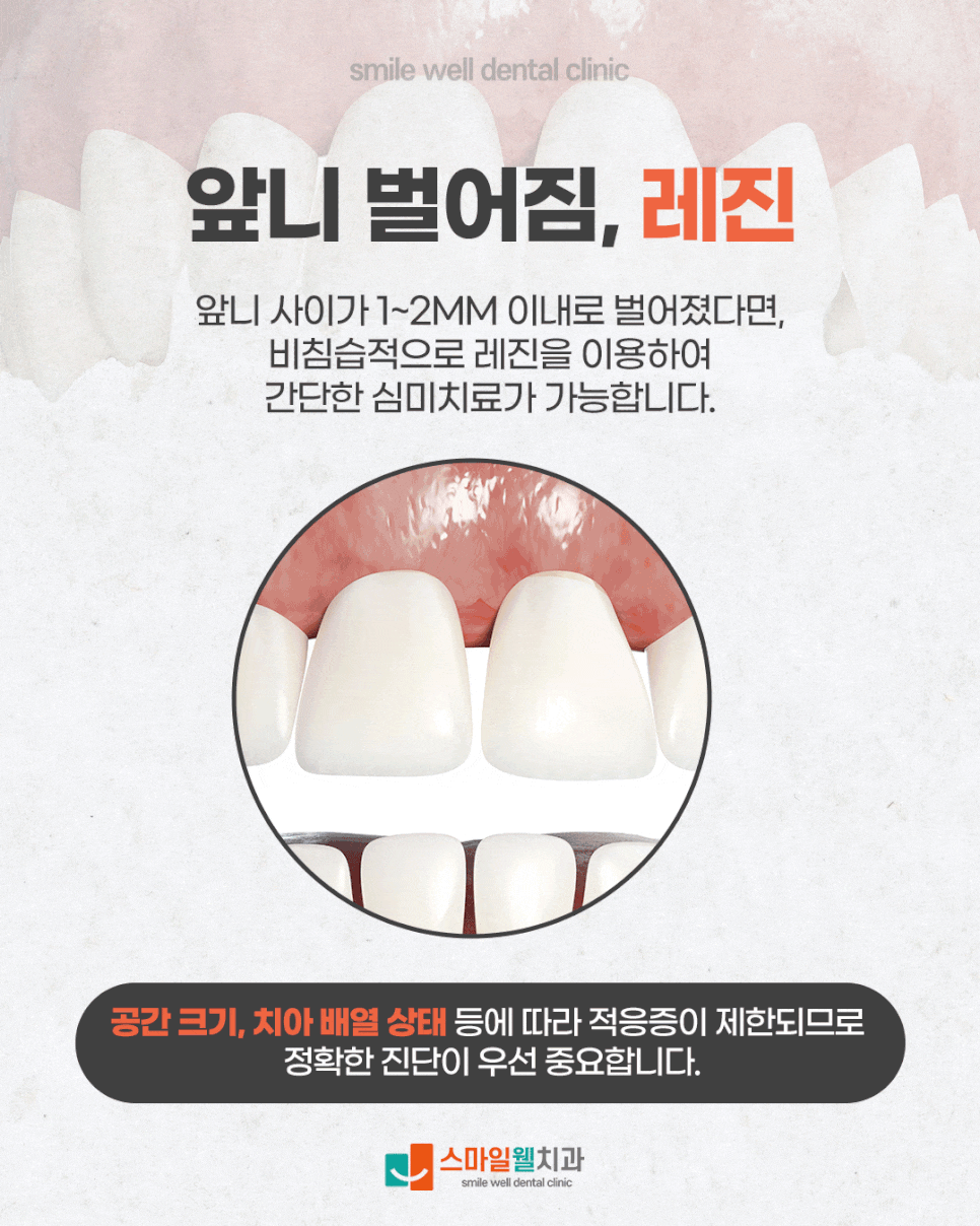 앞니 벌어짐 레진 치료, 1mm 미세한 틈도 가능할까요?