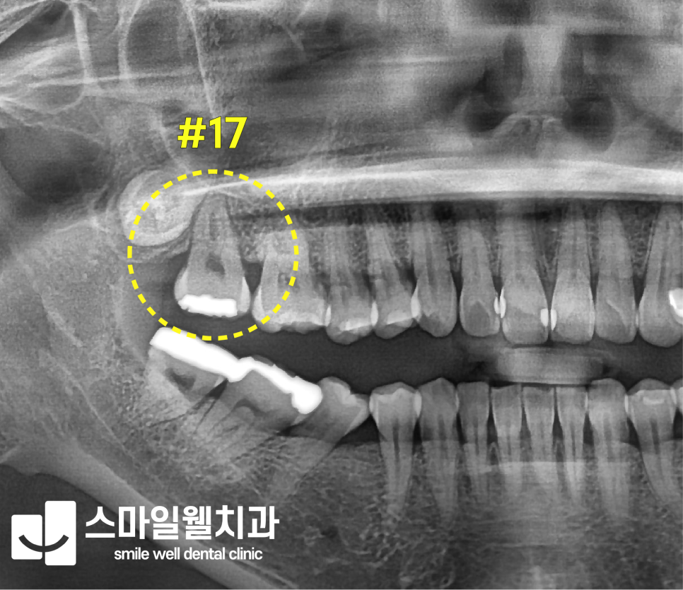인레이 당일 치료, 하루 만에 가능한가요? [디지털 보철 원리]