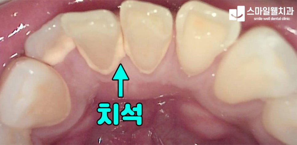 잇몸이 간지러워요? 원인과 대처법 3가지 정리
