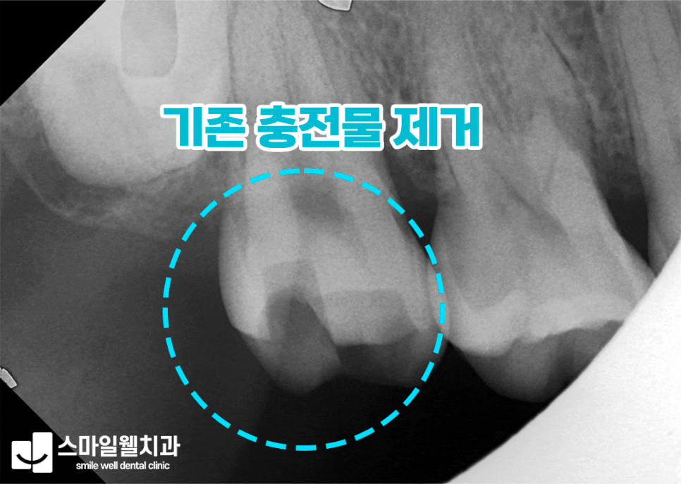 당일 인레이 가능한가요? 치과 내원 횟수 줄이는 방법