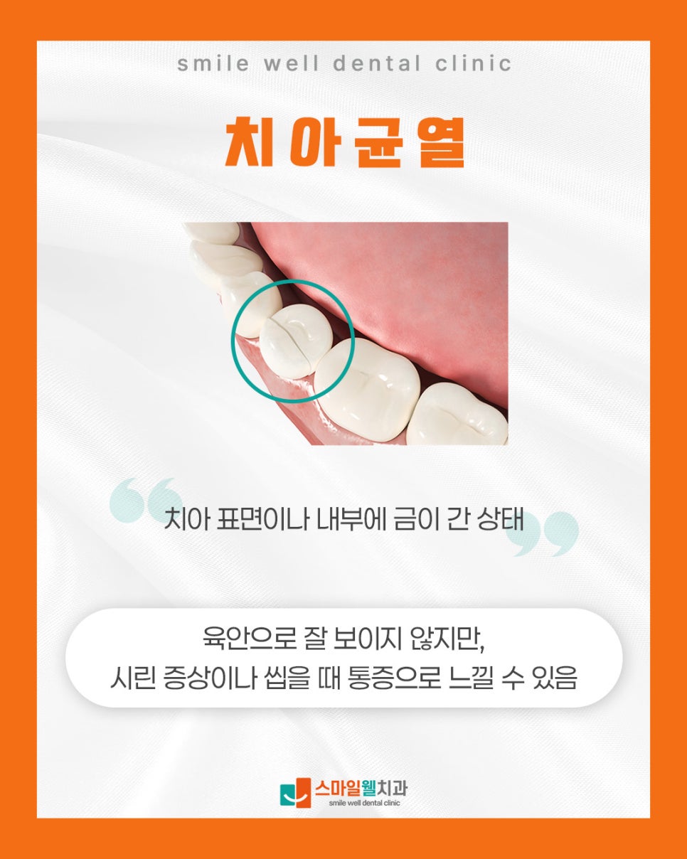 치아 균열, 찌릿한 통증 그대로 두면 안 되는 이유와 대처법