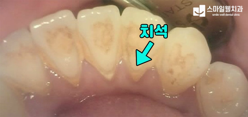 잇몸 염증, 그대로 두면 치아 빠질까? 잇몸치료 방법 정리
