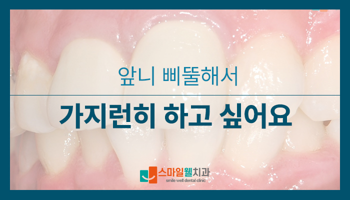 앞니 크라운 교체, 가지런한 미소를 위한 심미 치료 방법은?
