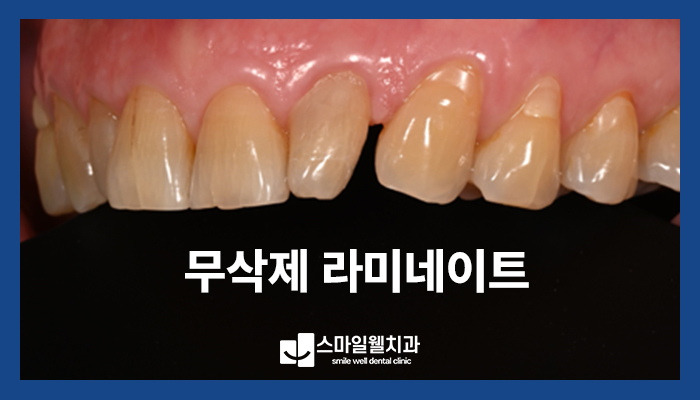 무삭제 라미네이트, 왜소치 개선을 위한 선택일까요?