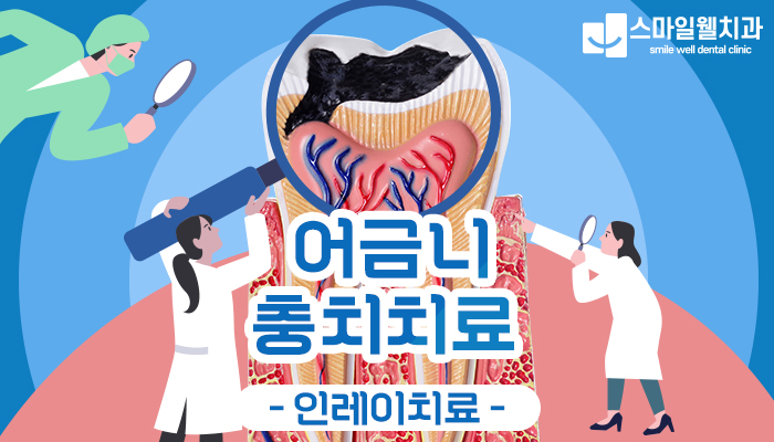 충치치료, 단계별 방법과 적절한 시기는? [치과의사 가이드]