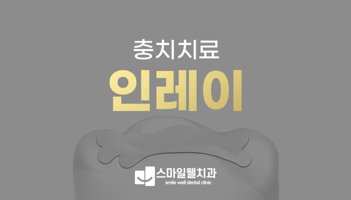 인레이 충치치료, 당일 제작이 가능한가요? [방법·주의사항]