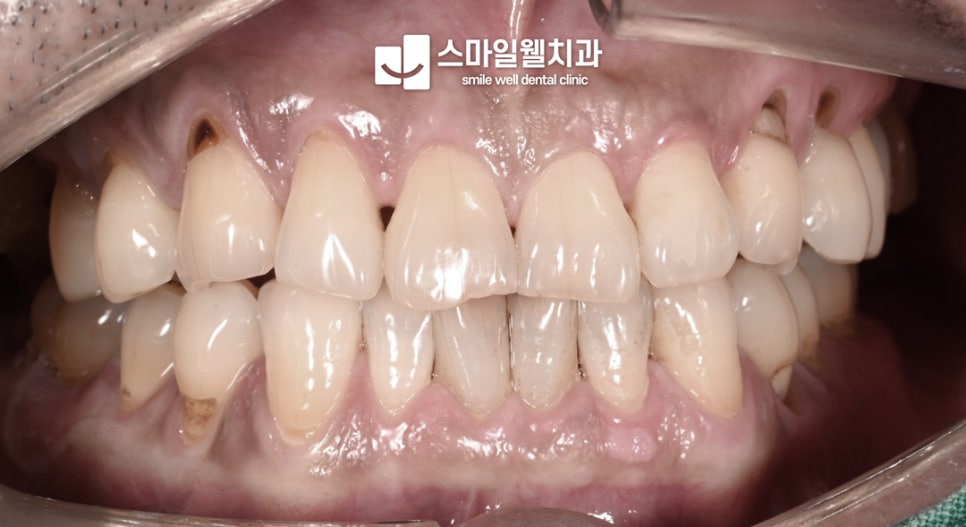 시린이 원인 치경부마모증, 레진과 GI 치료 차이는?
