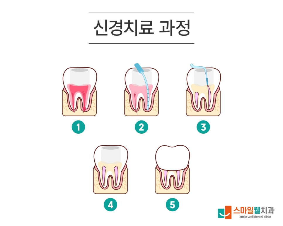 신경치료 기간, 보통 몇 번·몇 주 걸리나요?