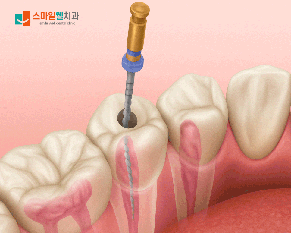 신경치료 후 통증, 왜 생길까요? [원인과 주의사항 정리]