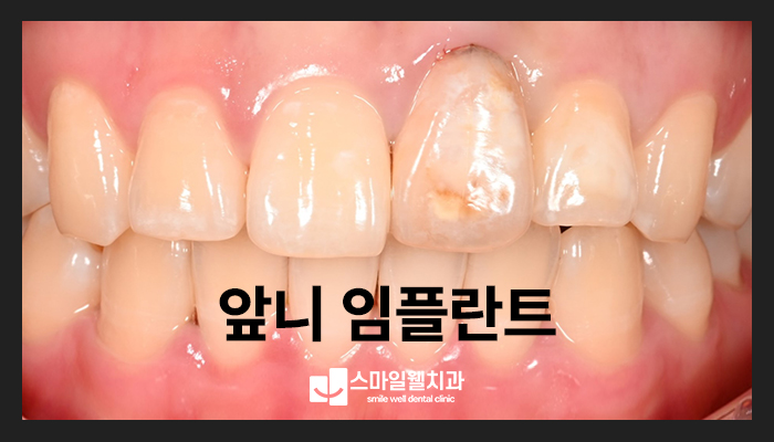 앞니 임플란트, 심미성과 기능 회복을 위한 고려사항은?
