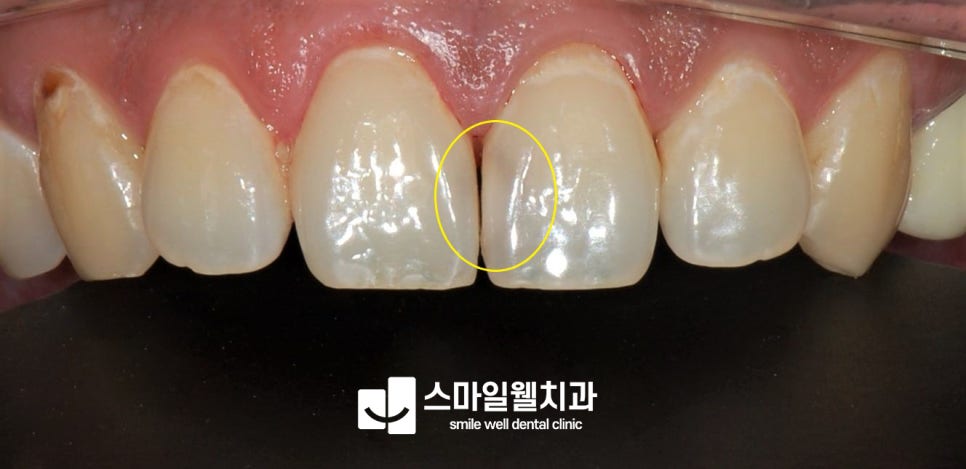 앞니 충치 레진, 당일 치료 가능한 경우와 주의사항은?