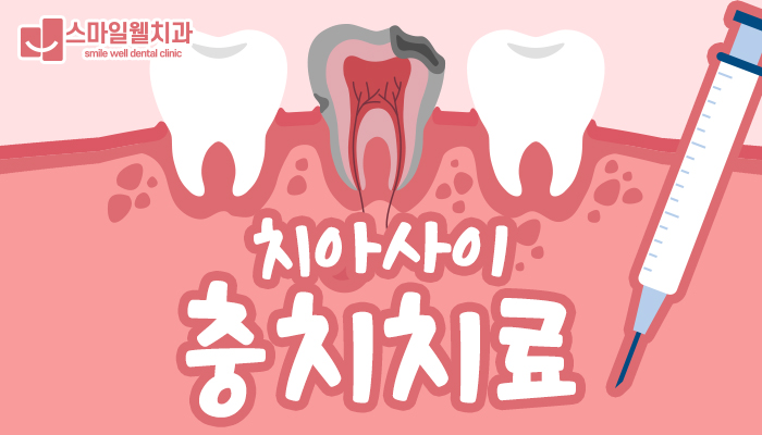 앞니 치아사이 충치, 그대로 두면 위험한 이유와 관리법