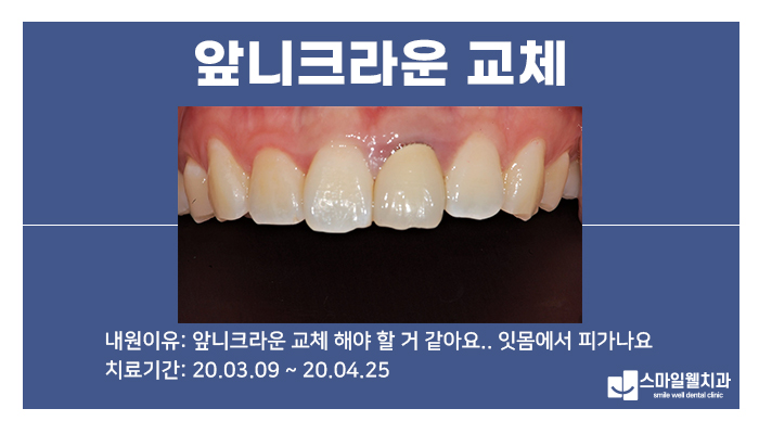앞니크라운 교체, 재신경치료가 필요한 이유와 과정은?
