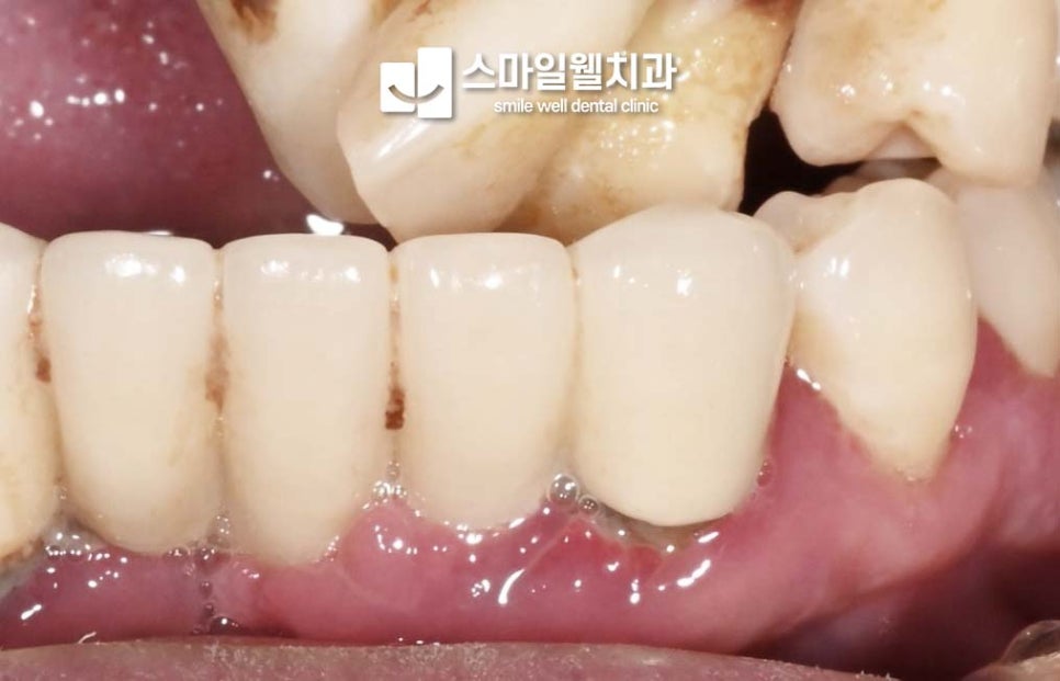 잇몸이 붓고 피가 나는 이유, 치석 때문일까요?