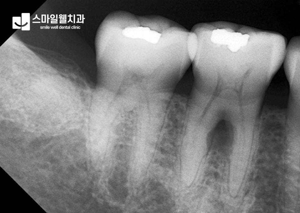 신경치료, 자연치아 살리는 방법은 무엇인가요?