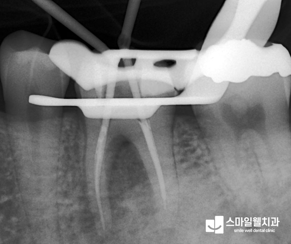 재신경치료, 왜 다시 해야 할까요? 자연치아 살리는 방법