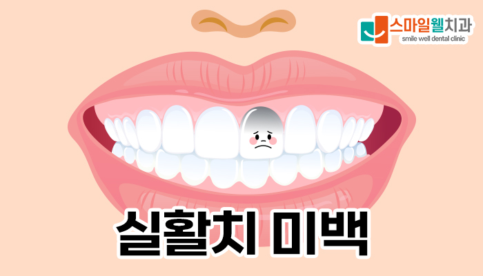 치아변색, 검게 변한 앞니 실활치미백으로 해결할 수 있을까?