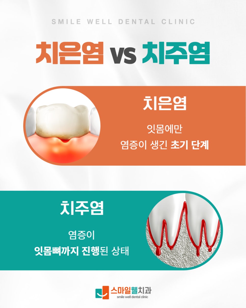 치은염 치주염 차이, 잇몸 부기와 피가 난다면 확인하세요