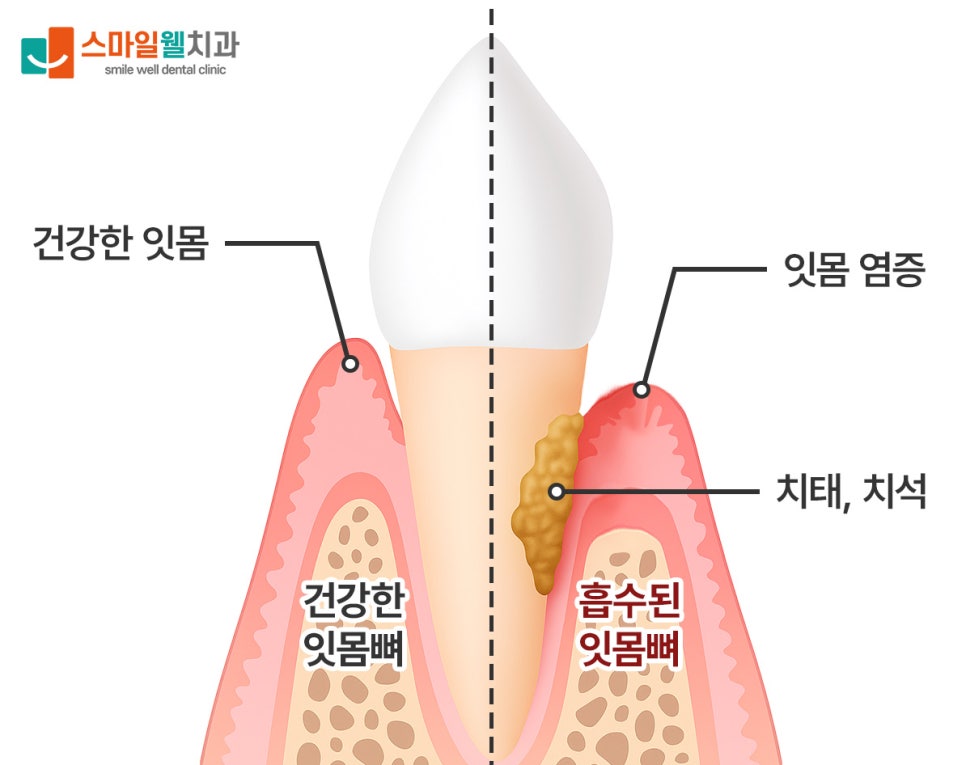 양치할 때 피가 나요? 잇몸 출혈 원인과 관리법
