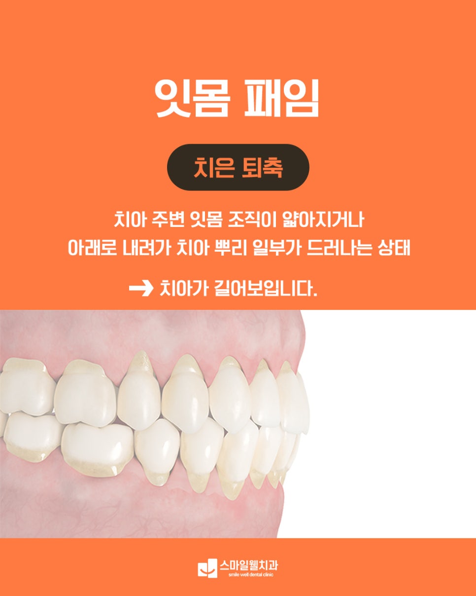 잇몸 패임, 그대로 두면 치아 상실까지? 원인과 예방법 정리