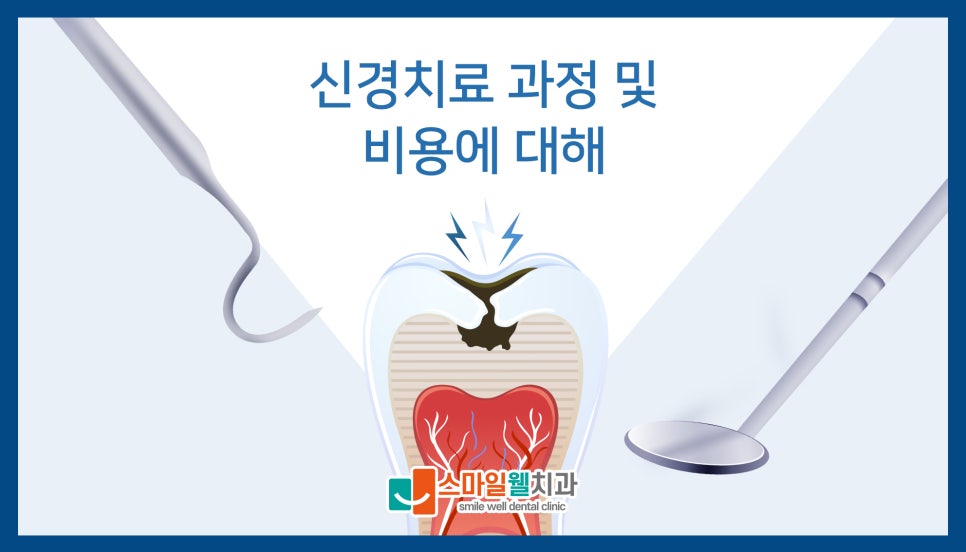 신경치료 과정, 단계별 소요 기간과 비용은 얼마인가요?