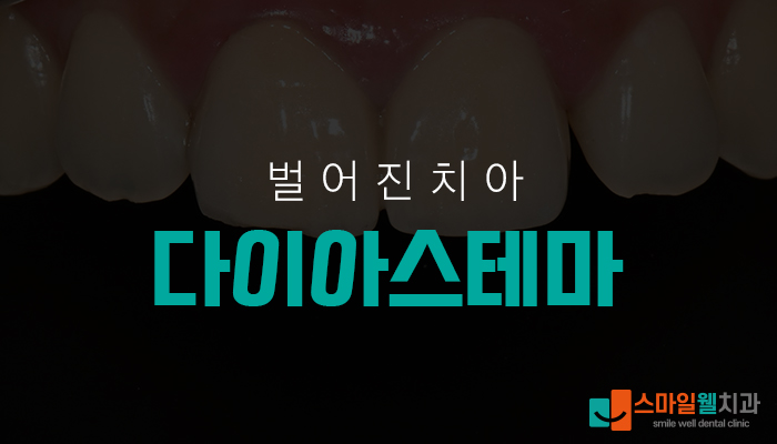 벌어진 치아 레진치료, 당일 마무리 가능한가요?