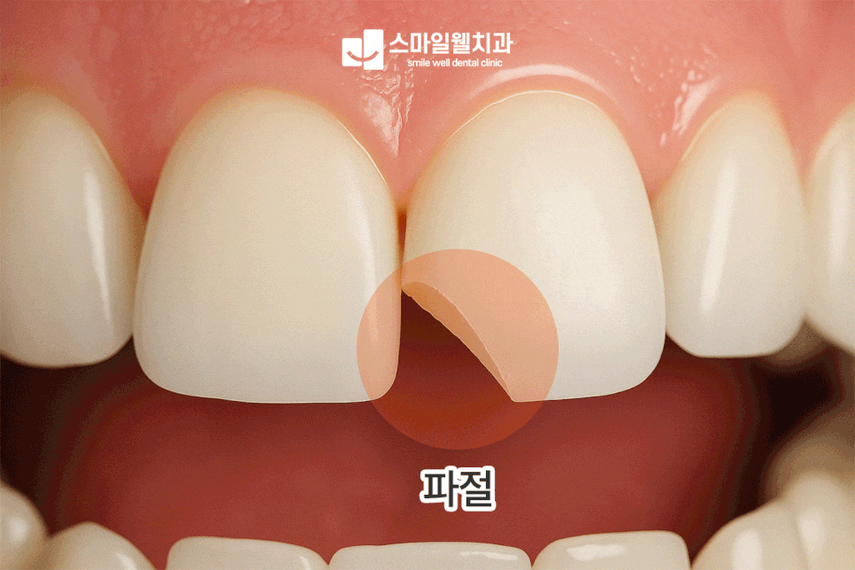 레진 라미네이트 차이점, 나에게 맞는 앞니 심미치료는?