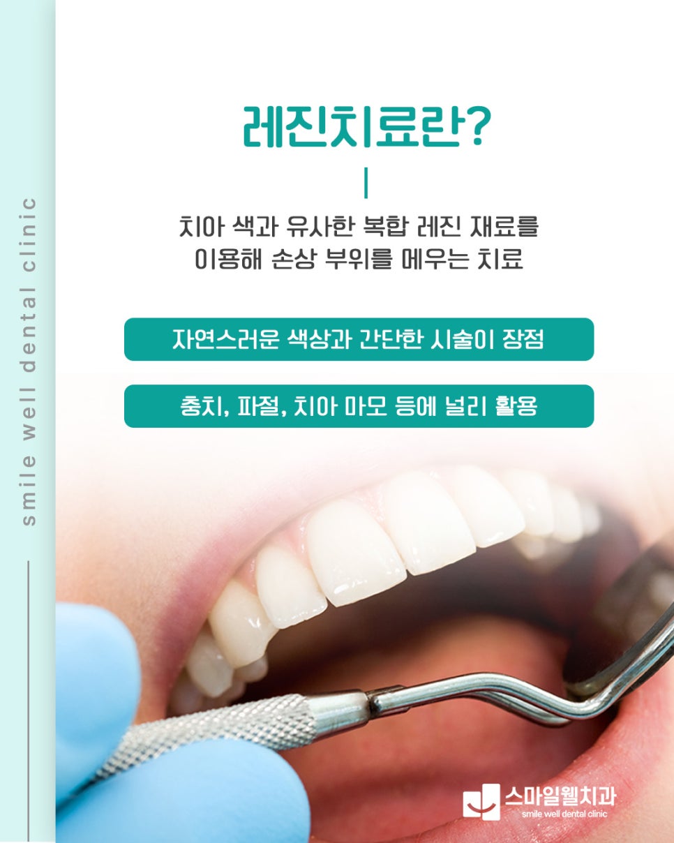 레진 치료, 언제 해야 할까요? 치과의사가 알려주는 적정 시기