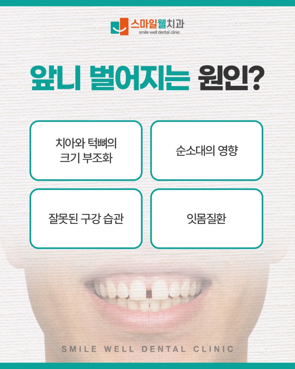 앞니 벌어짐 레진 치료, 당일 개선이 가능할까요?