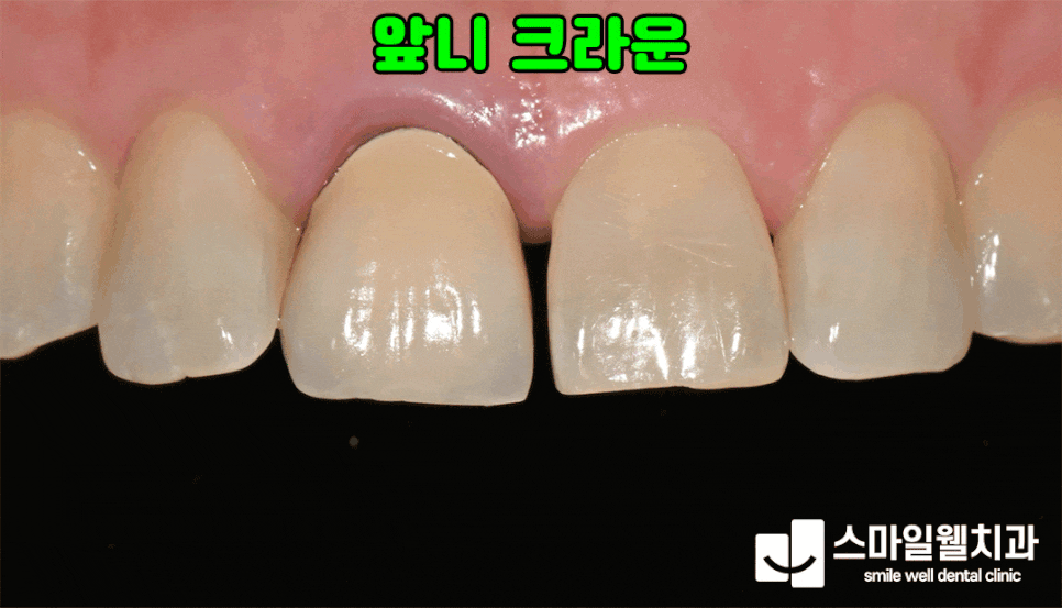 보철 수명, 어떻게 늘릴까요? 오래 사용하는 3가지 방법