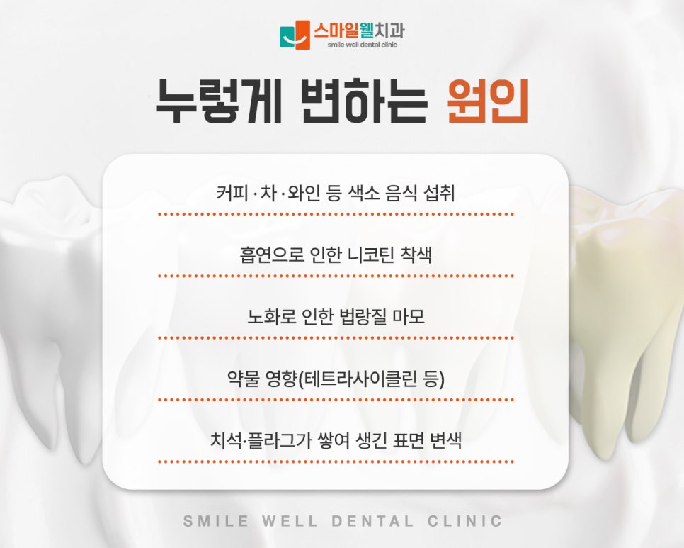 치아미백, 누런 치아 밝게 만드는 방법은? [원인·주의사항]