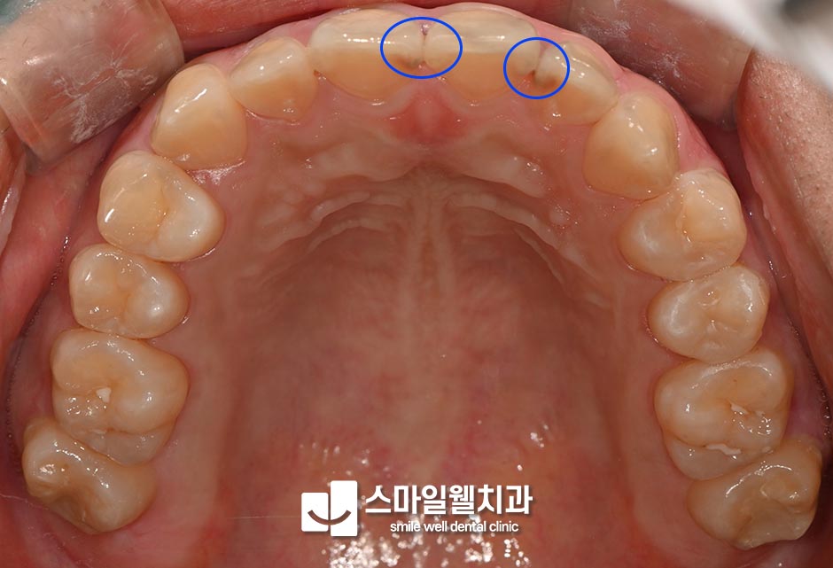 충치 치료 단계별 방법, 증상에 따라 어떻게 다를까요?