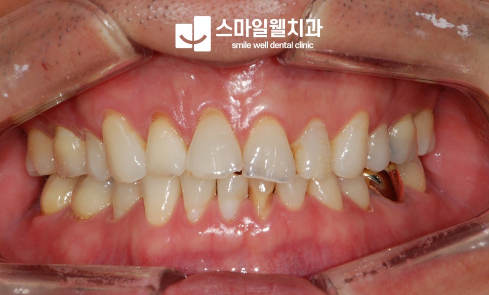 치아 마모 원인 4가지, 왜 자꾸 닳고 시릴까요?