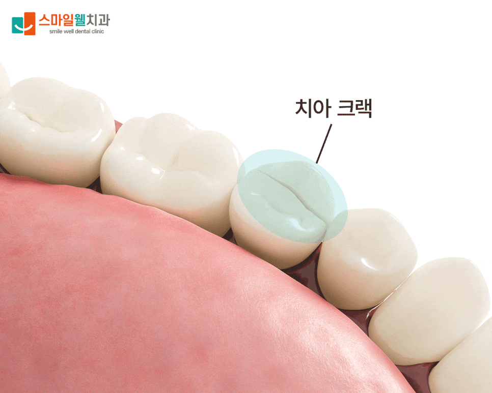 치아 크랙 증상, 딱딱한 음식 즐긴다면 꼭 확인하세요