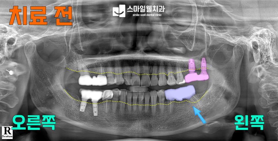자연치아 살리기, 발치 전 꼭 확인해야 할 3가지