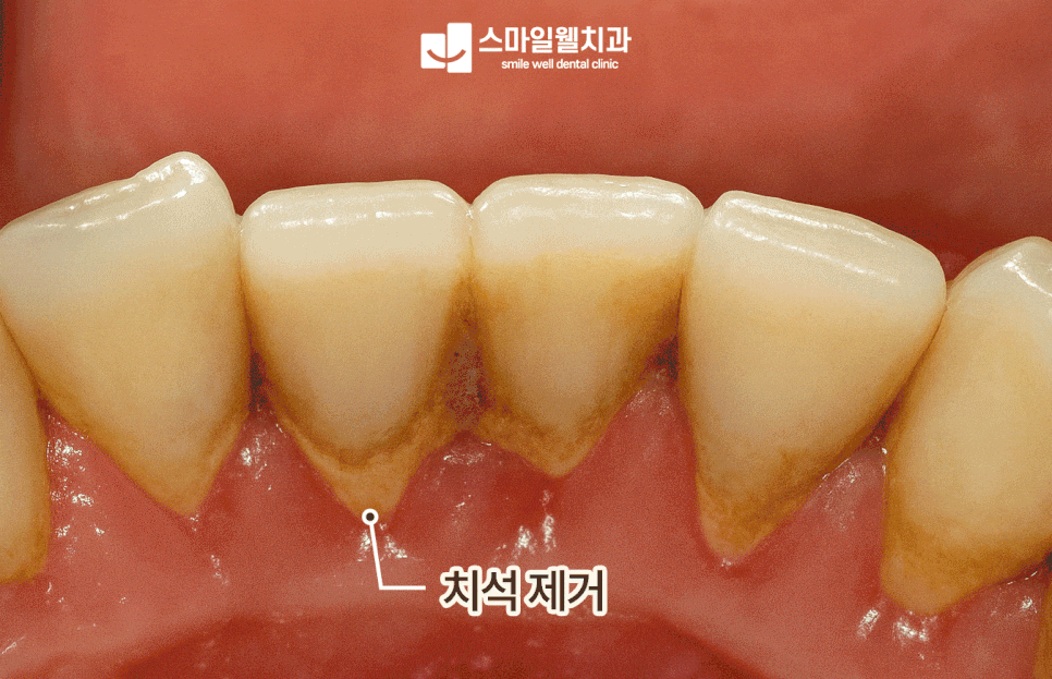 스케일링 후 이가 시린 이유, 왜 나타날까요? [원인·관리법]