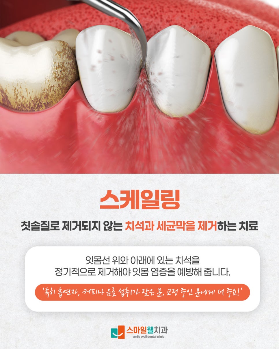 스케일링 주기, 왜 1년에 한 번은 꼭 받아야 할까요?