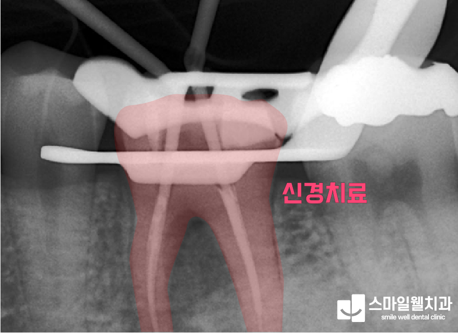 신경치료, 자연치아 살리는 방법과 주의사항은?