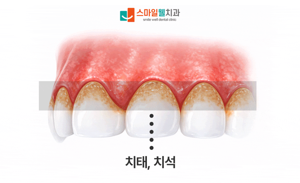 충치 치료, 통증 없어도 당장 해야 할까요? [단계별 증상 정리]