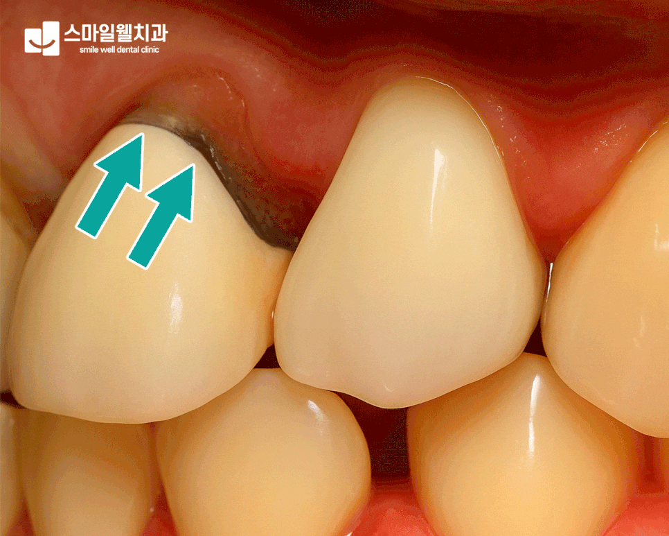 앞니 크라운 경계가 보인다면? 교체 신호와 주의사항 정리