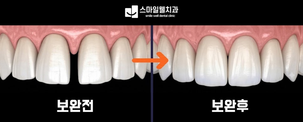 앞니 크라운 종류, 심미성과 강도 중 무엇이 더 중요할까요?