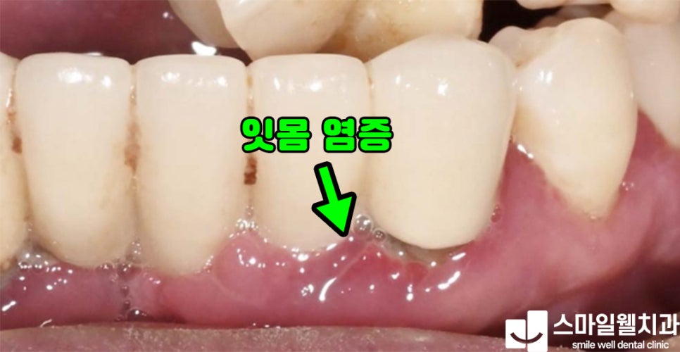 스케일링 보험 적용, 만 19세 이상이라면 꼭 확인하세요