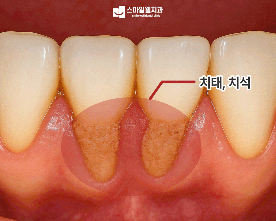 잇몸 염증, 그대로 두면 치아 상실까지? 증상과 관리법