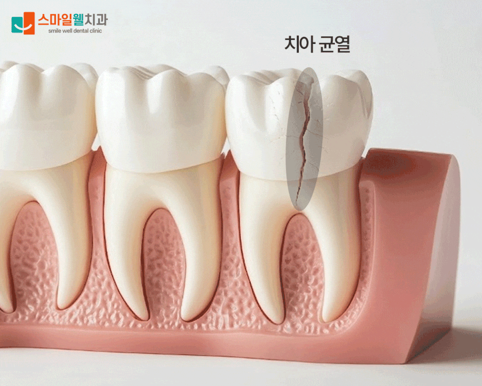 치아 균열, 찌릿한 통증 그대로 두면 안 되는 이유 3가지