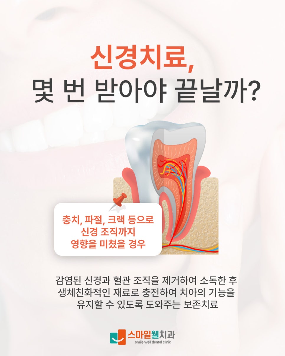 신경치료 횟수, 보통 몇 번 받아야 하나요? [치료 과정 정리]