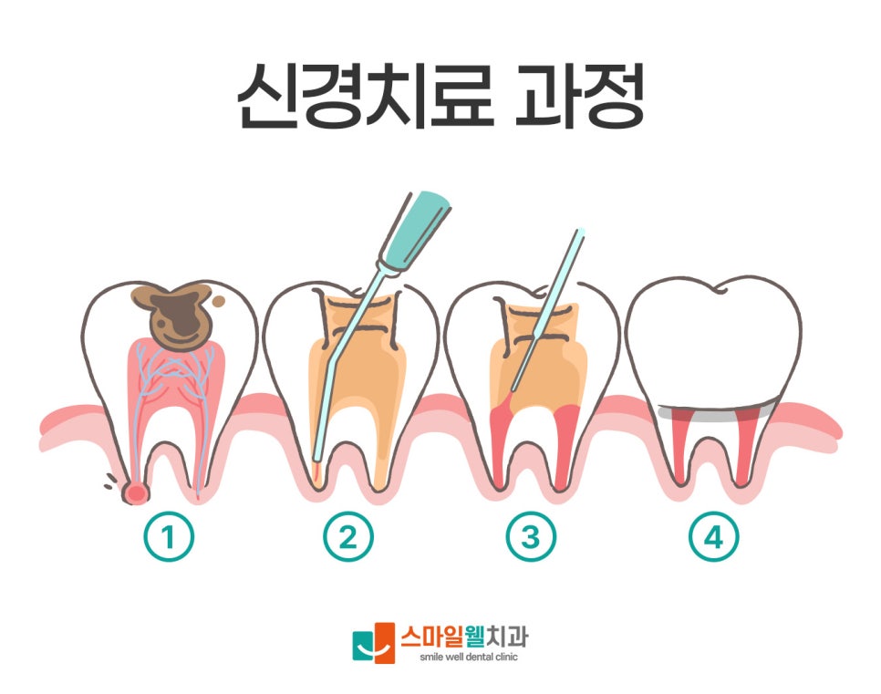 신경치료 후 통증, 정상인가요? 치과의사가 알려주는 원인과 대처법